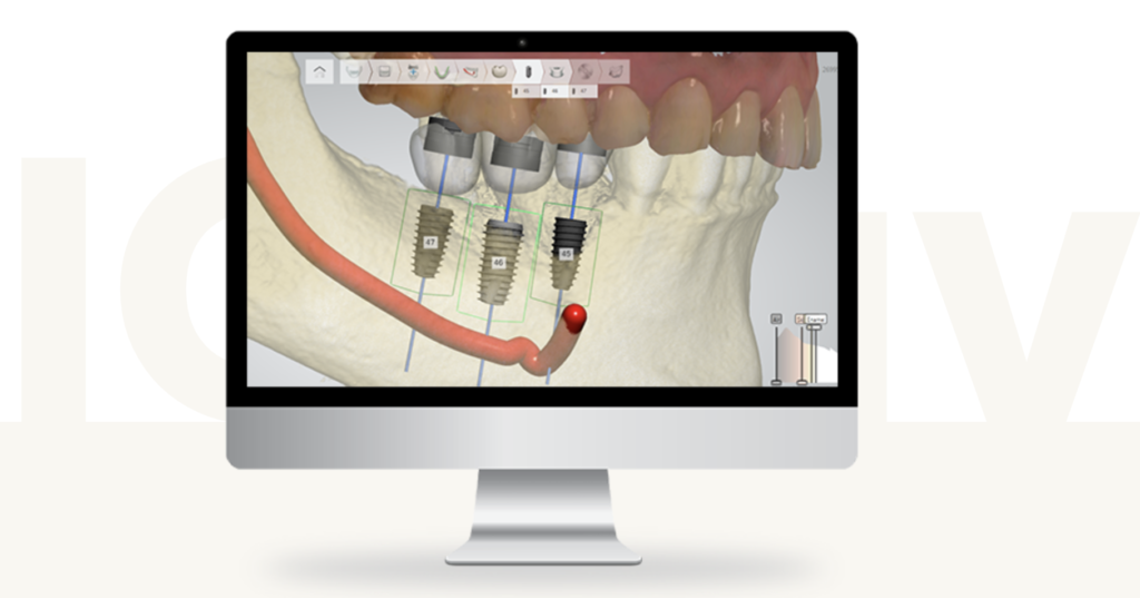 디오 임플란트 3D 모의수술