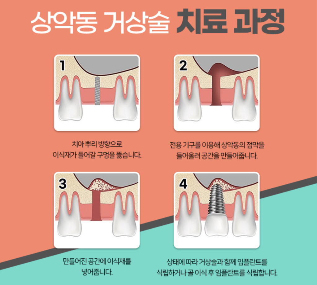 상악동 거상술 치료과정