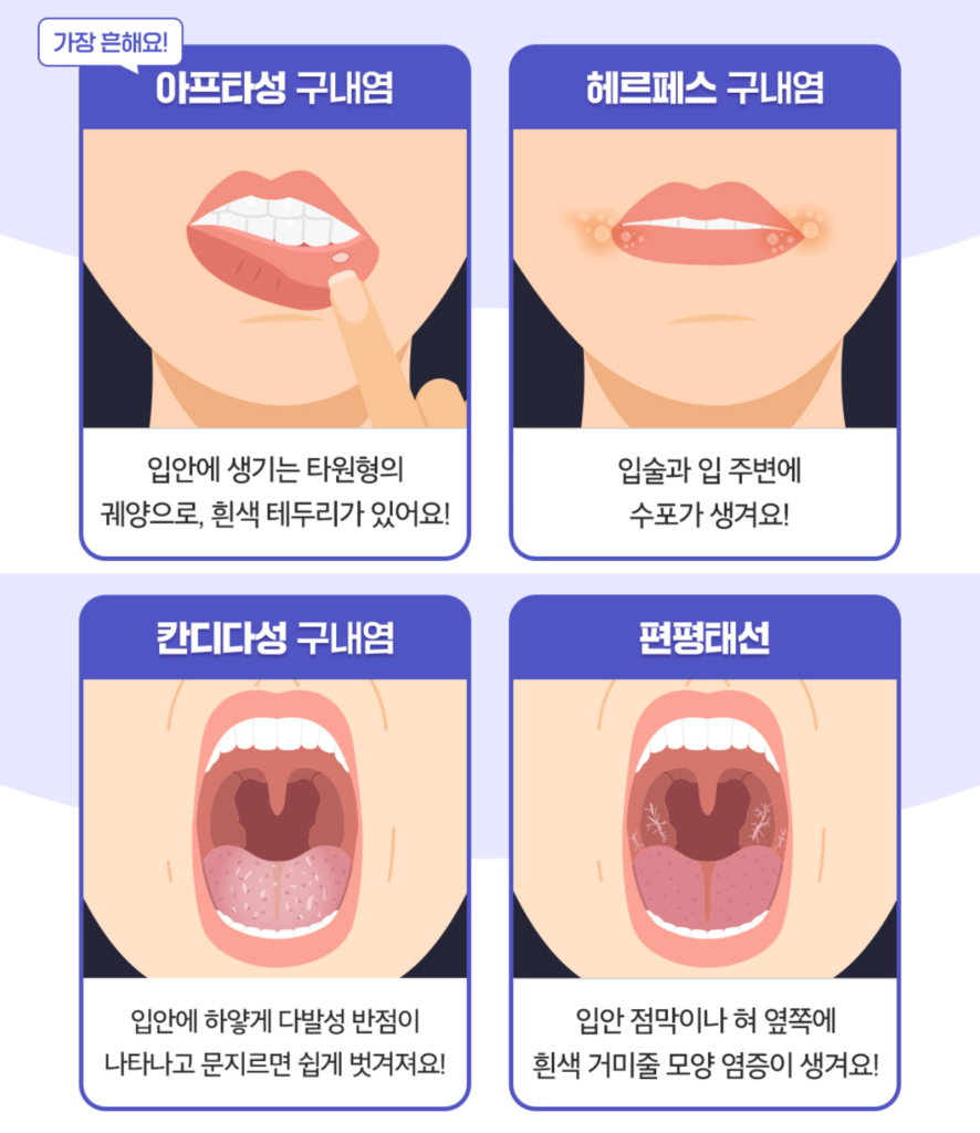 구내염의 종류