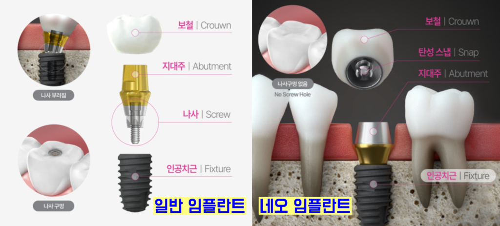 일반 임플란트 vs 네오 임플란트 비교