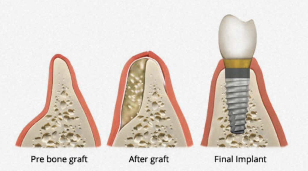 임플란트 뼈이식