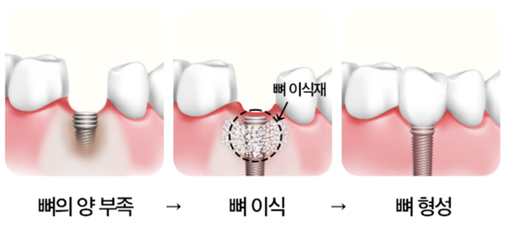 임플란트 뼈이식 과정