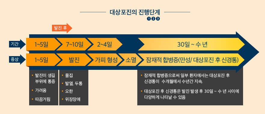 대상포진의 진행단계