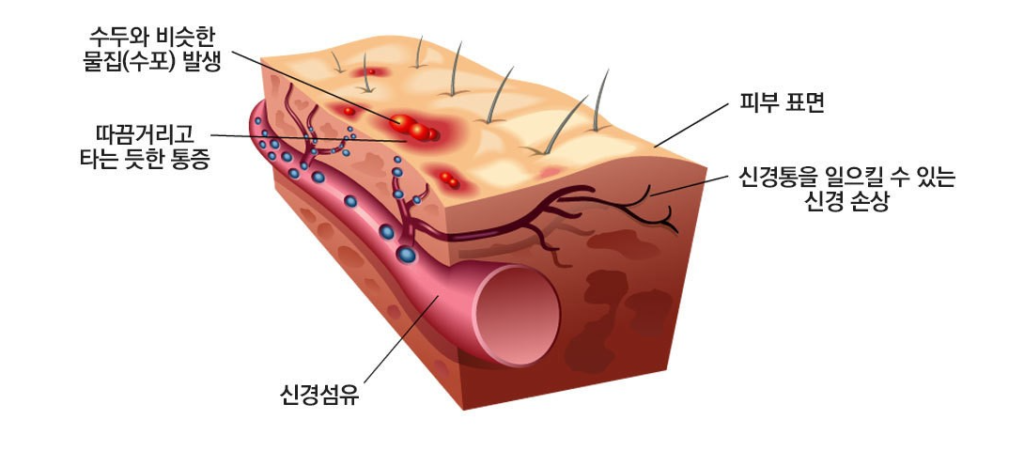 대상포진