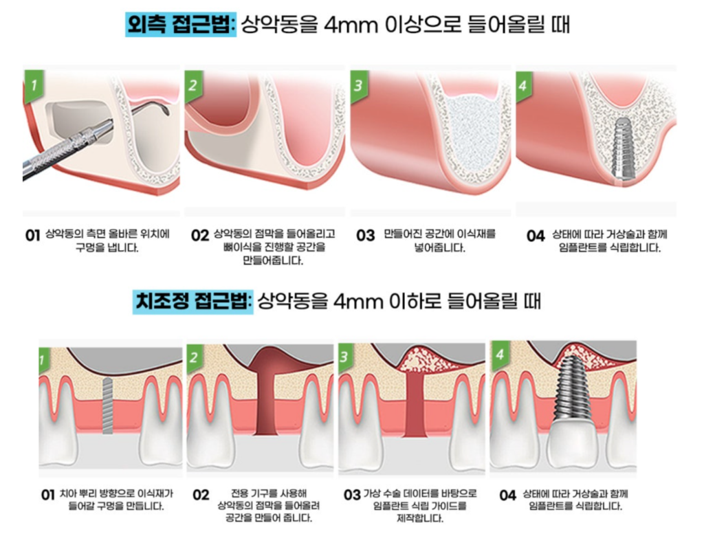 상악동 거상술 수술방법(외측 접근법, 치조정 접근법)