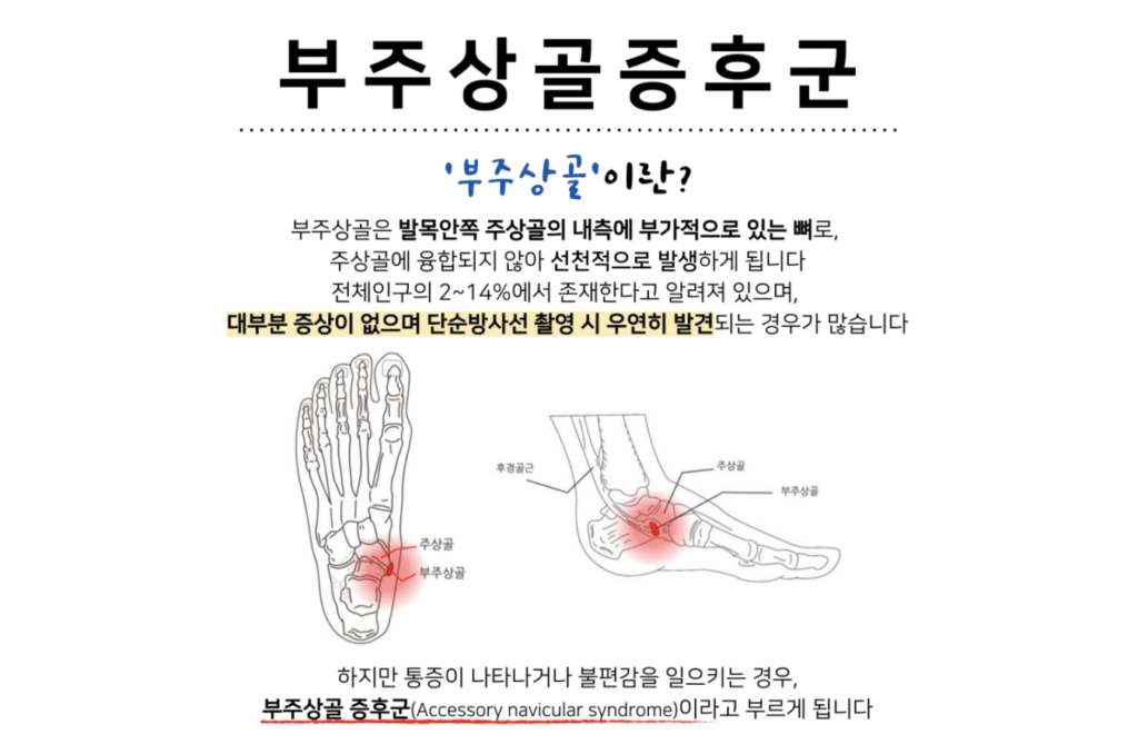 부주상골 증후군