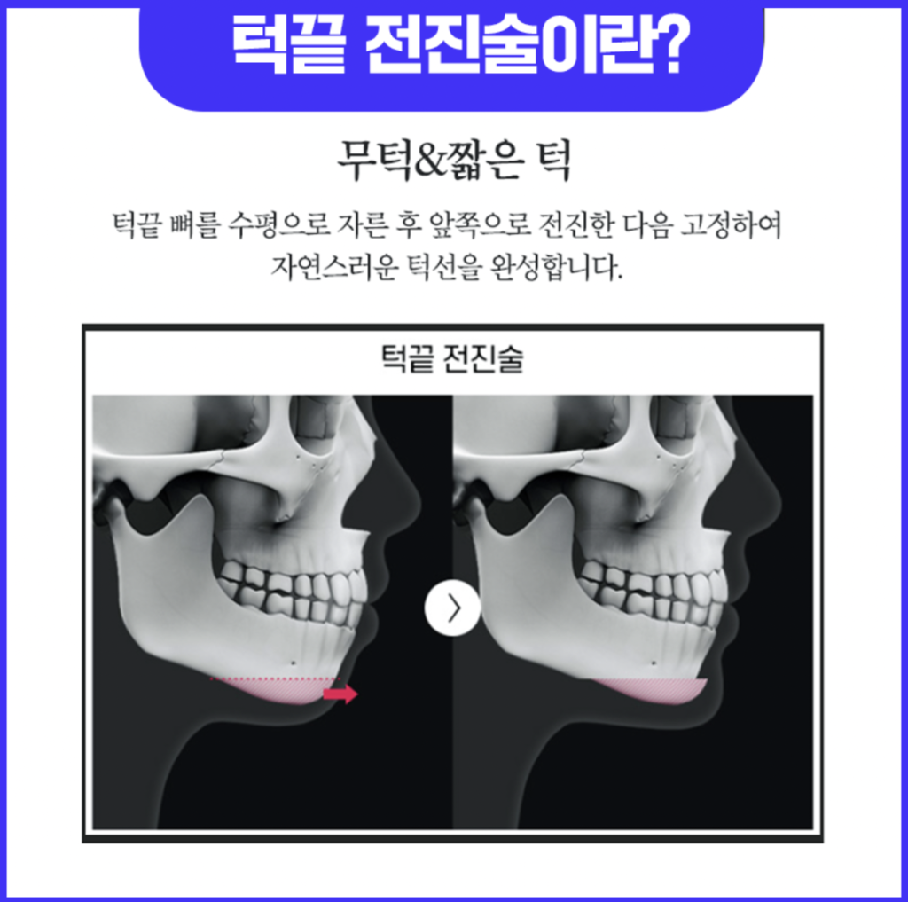 턱끝전진술이란?